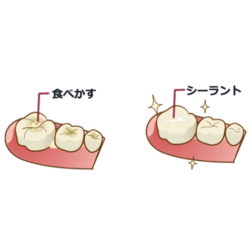 シーラント処置