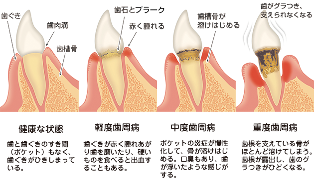 歯周病の進行