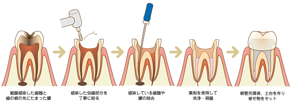 根管治療の流れ