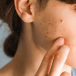 ニキビで悩む女性