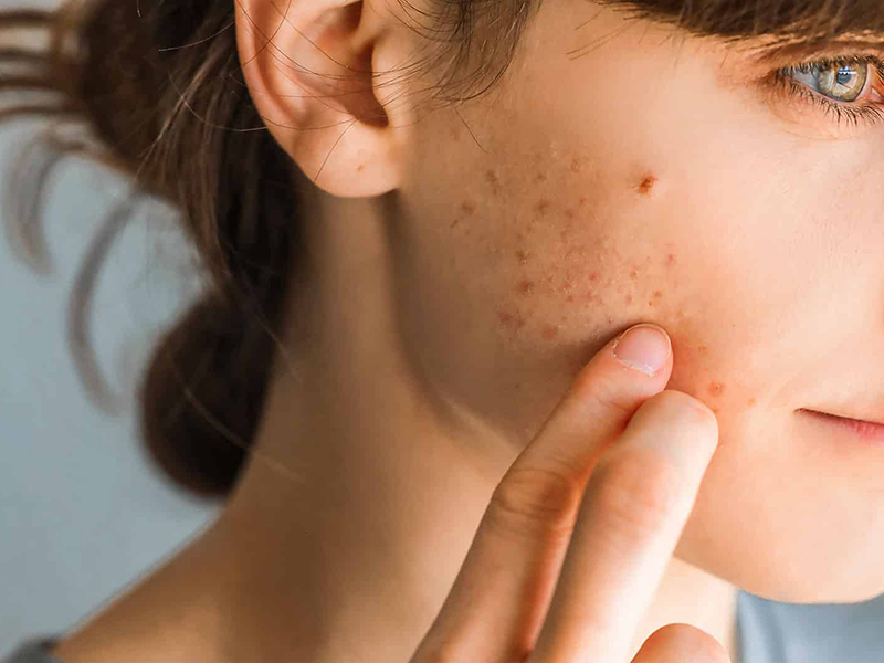 ニキビで悩む女性