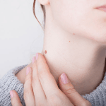 首のいぼが気になる女性