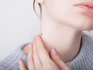 首のいぼが気になる女性