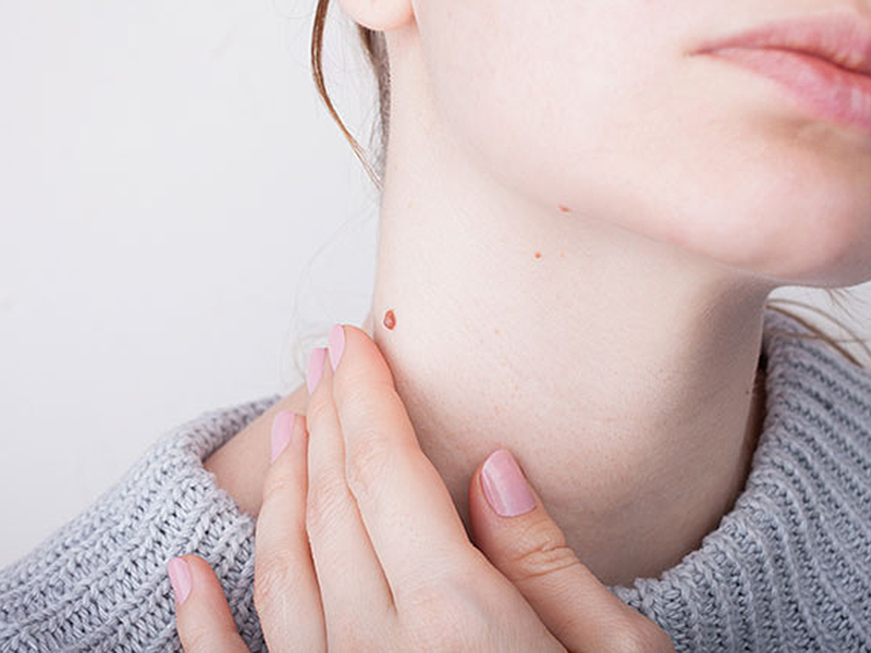 首のいぼが気になる女性