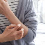 アトピー性皮膚炎で悩む女性