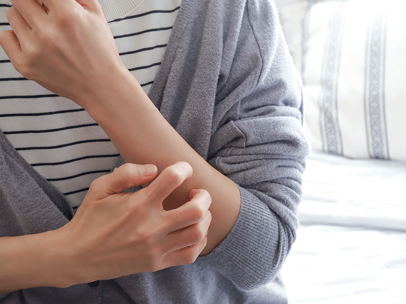 アトピー性皮膚炎で悩む女性