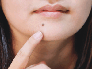 ほくろが気になる女性