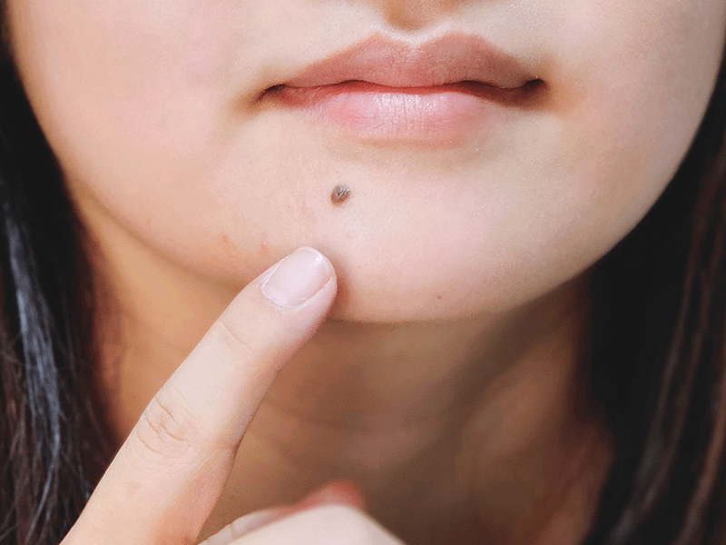 ほくろが気になる女性